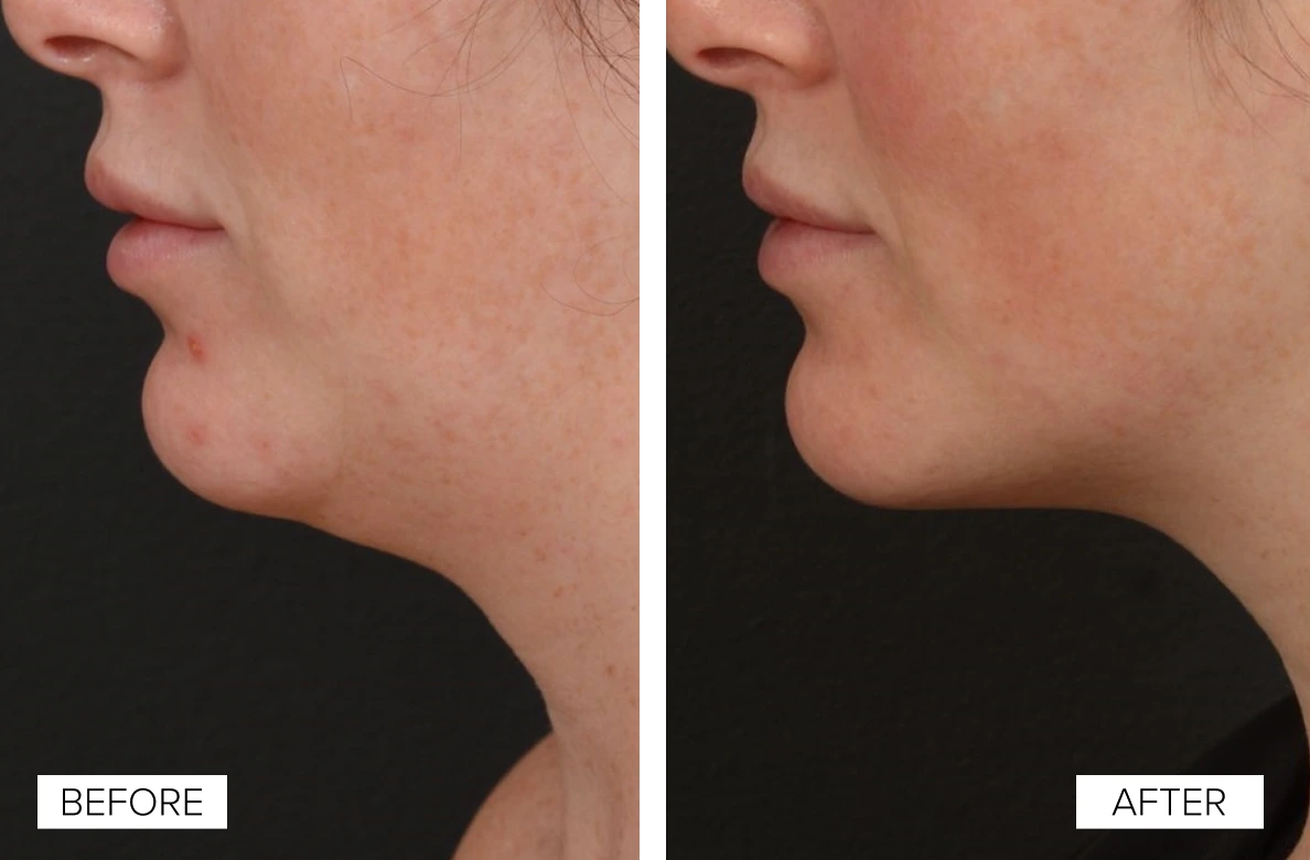 Side-by-side before and after comparison of lower face showing reduced texture and improved skin smoothness after Sofwave treatment
