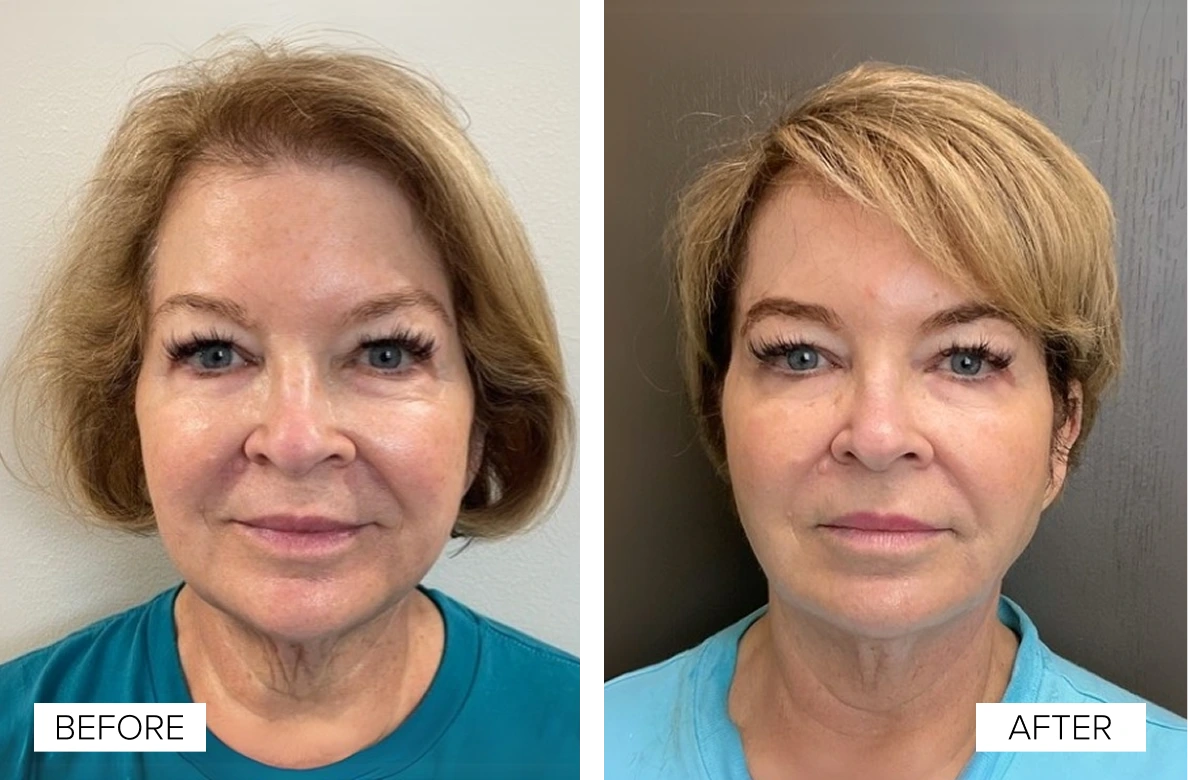 Before and after frontal facial photos showing improved skin tone and reduced fine lines after Sofwave treatment
