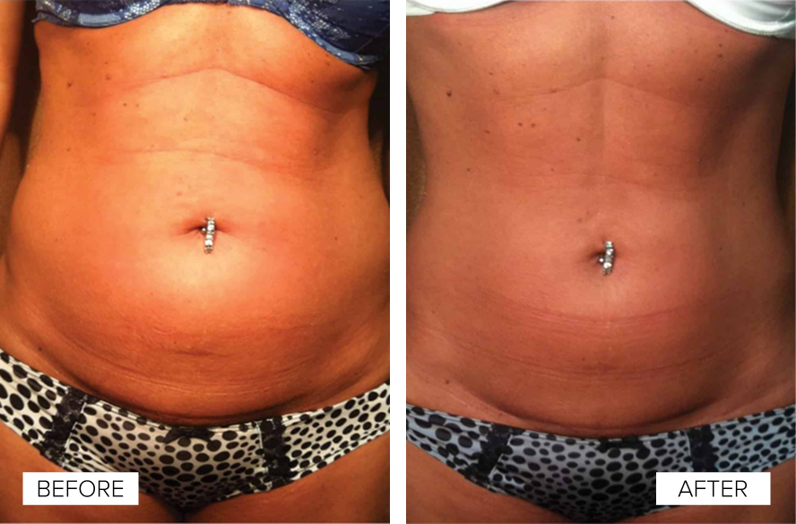 Before and After Gallery: Venus Freeze Banner