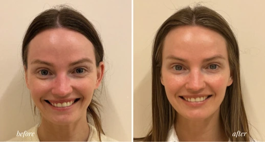 Botox (2)