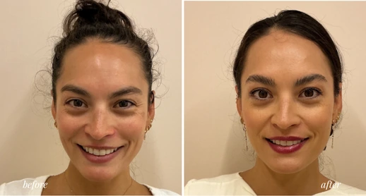 Botox (3)