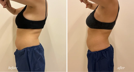 Coolsculpting (1)