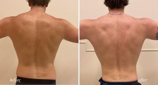Emsculpt case 1b