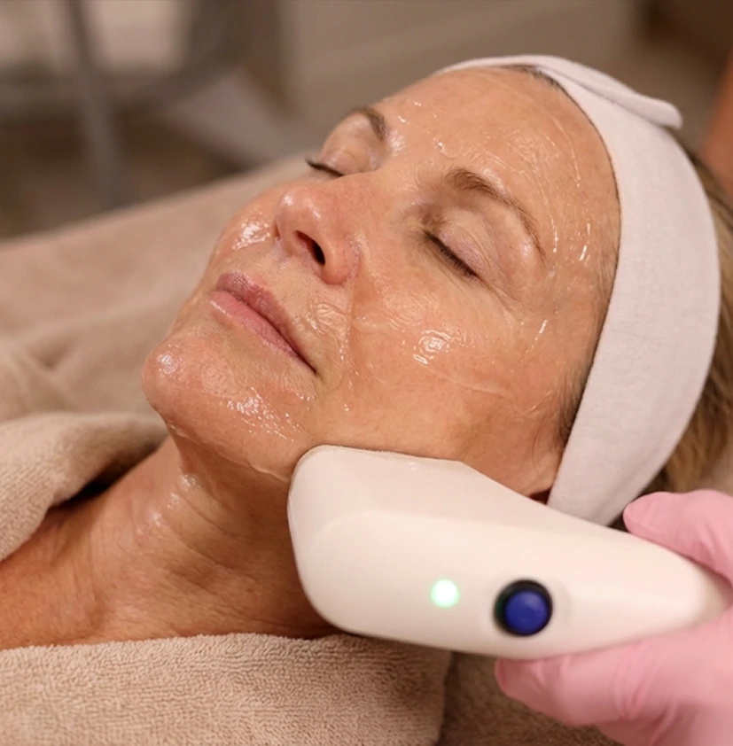 Sofwave™ handheld device applied to patient's cheek during facial treatment