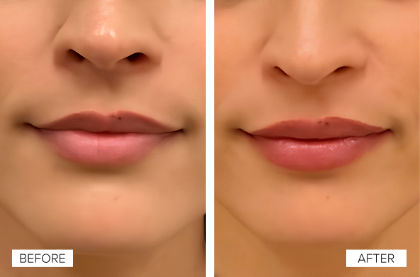Lip Filler in NYC Before After Banner