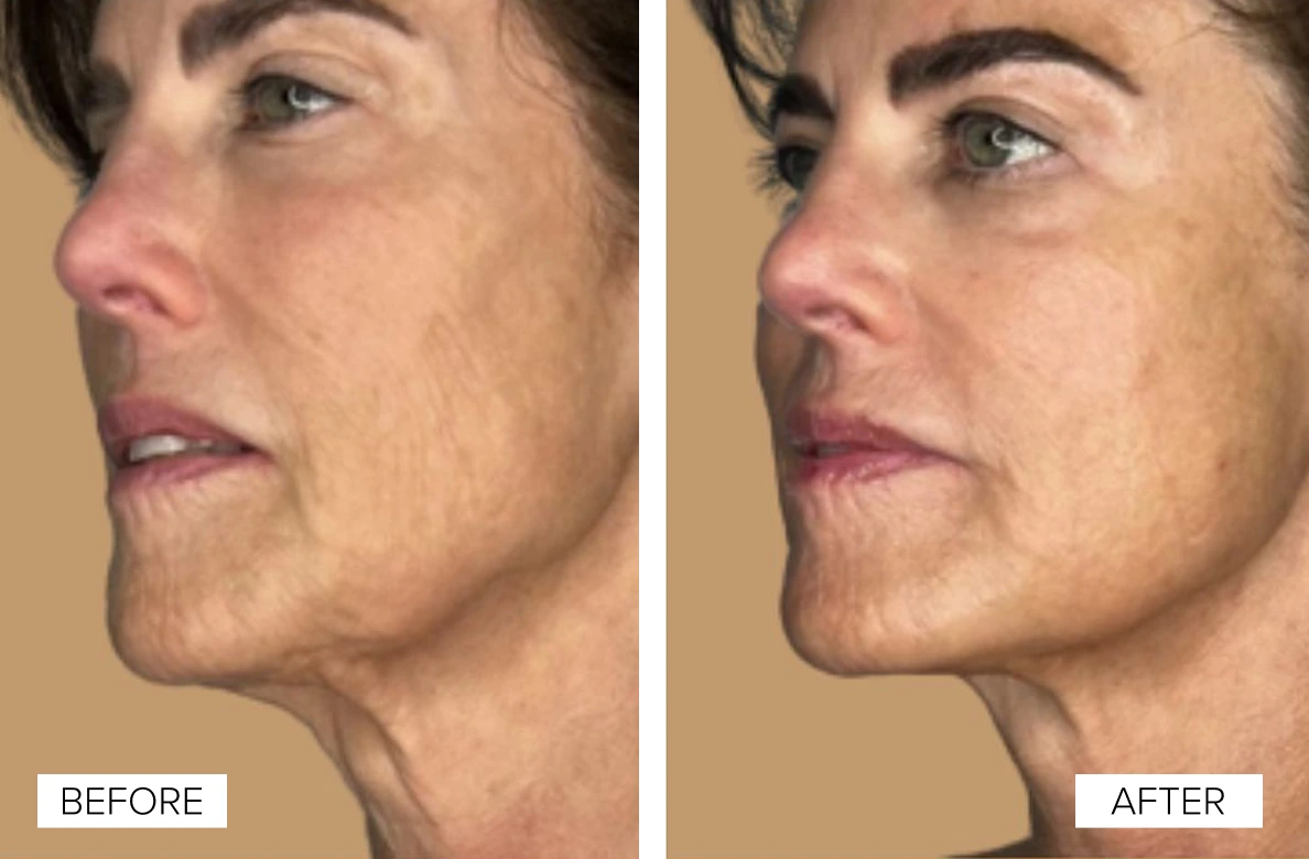 Woman's profile before and after Sofwave treatment, showing refined facial contours and reduced wrinkles