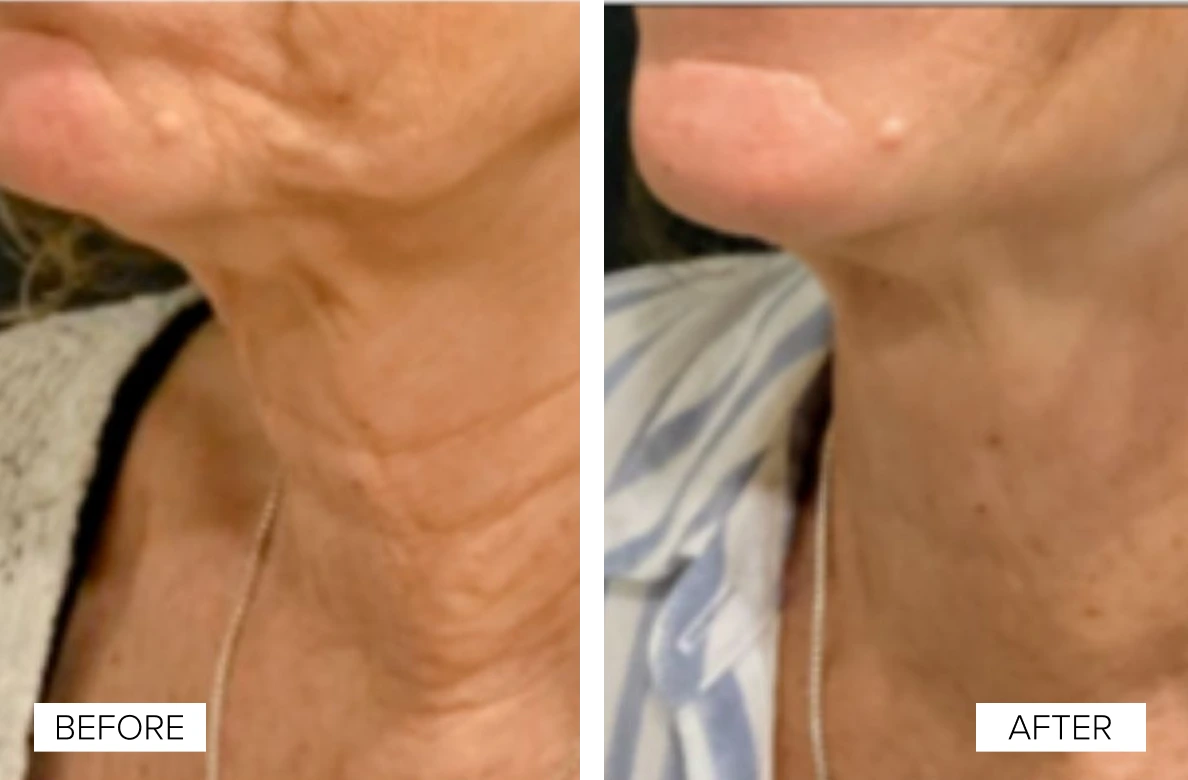 Close-up of neck and décolletage before and after Sofwave treatment, showing smoother skin texture