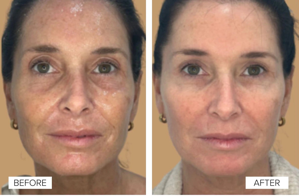 Woman's face before and after Sofwave treatment, showing reduced fine lines and improved skin clarity
