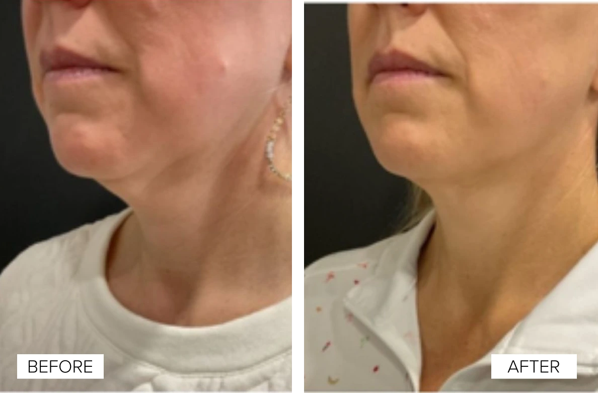 Woman's jawline and neck before and after Sofwave treatment, showing improved skin texture and definition