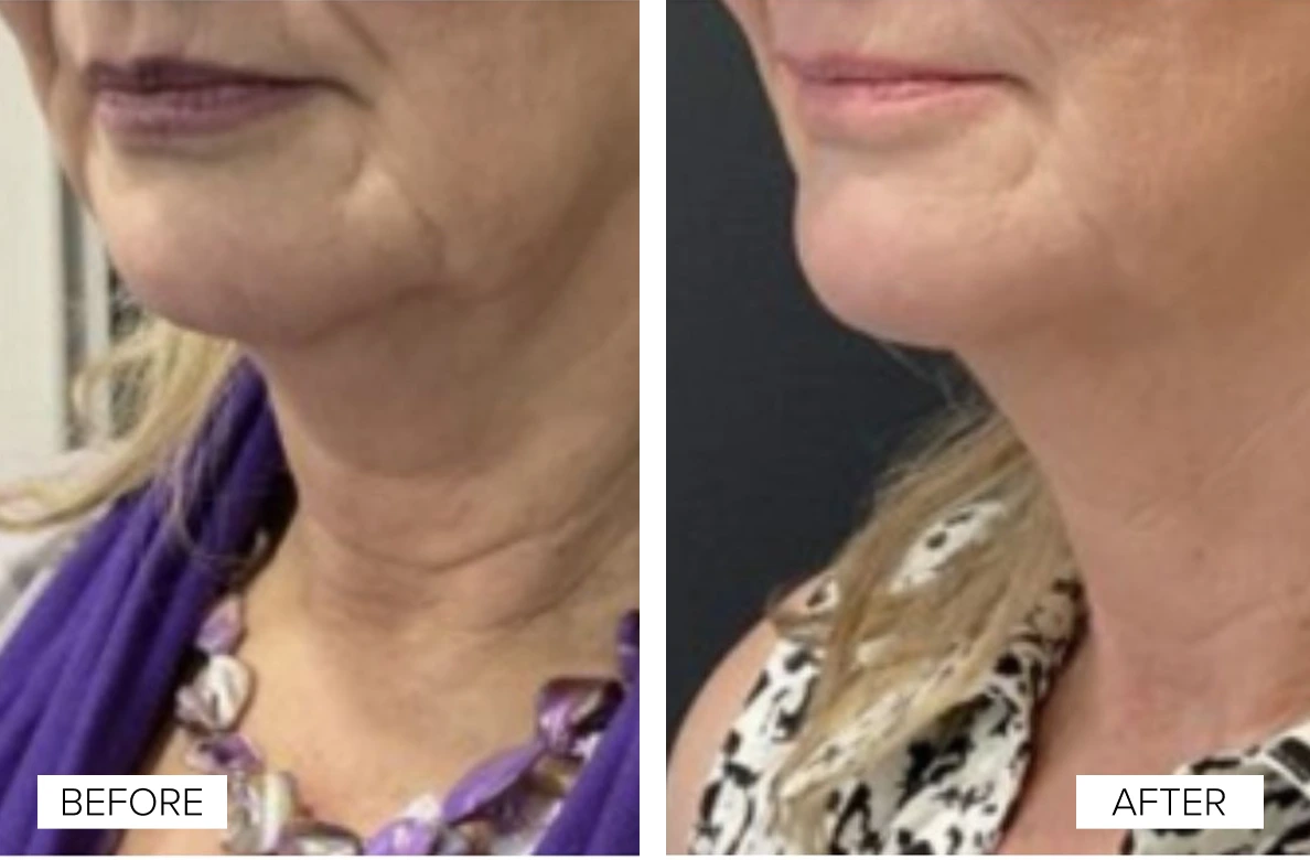 Before and after neck and jawline comparison showing improved skin firmness