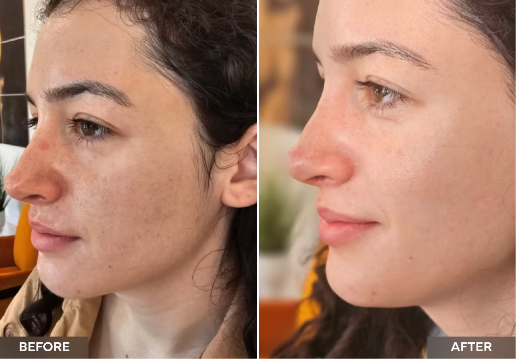 Side profile before and after showing refined skin texture and reduced blemishes