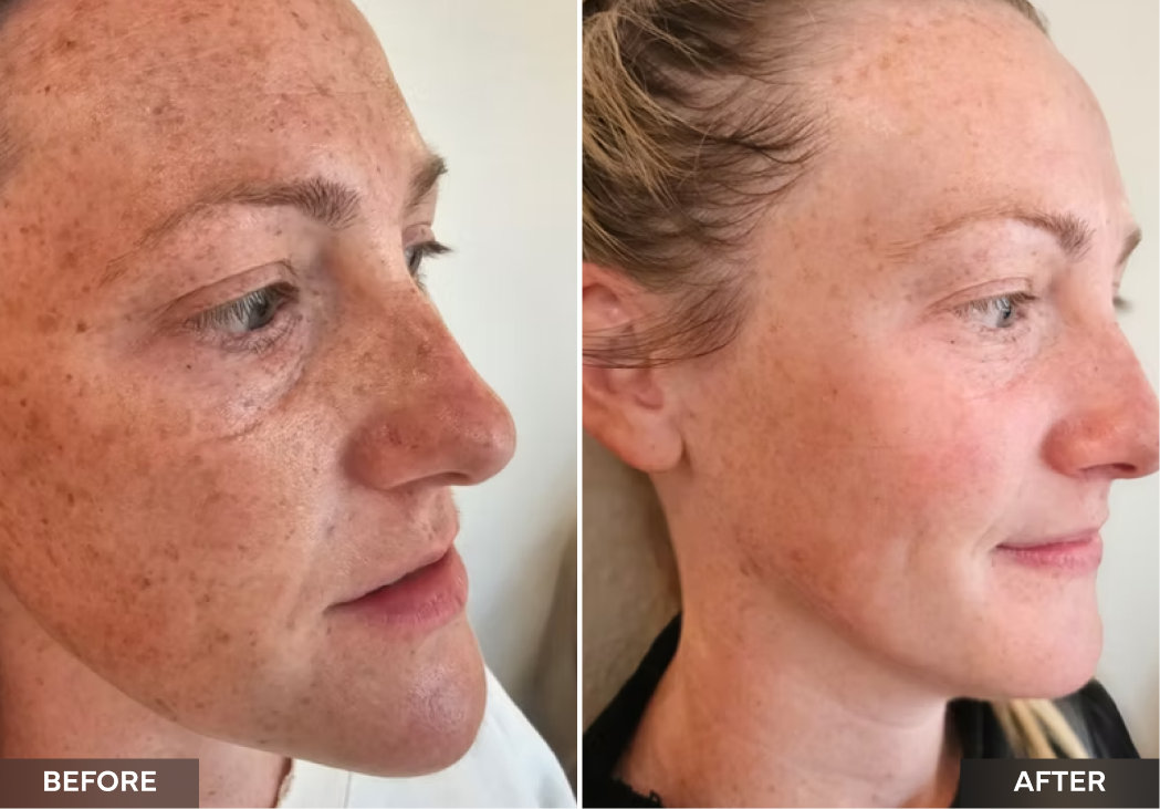 Side profile before and after showing improved skin clarity and reduced age spots
