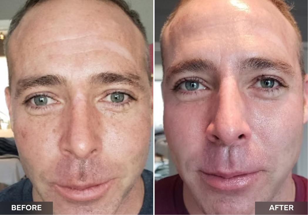 Before and after facial comparison showing reduced wrinkles and improved skin texture