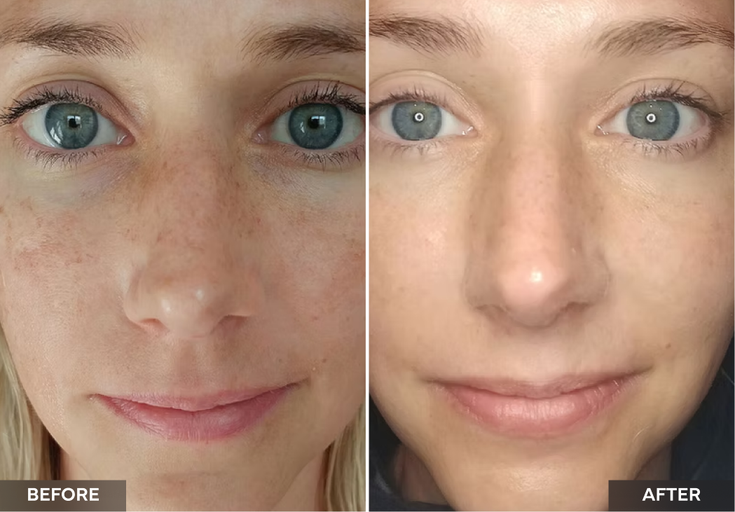 Full face before and after showing improved skin tone and reduced under-eye puffiness