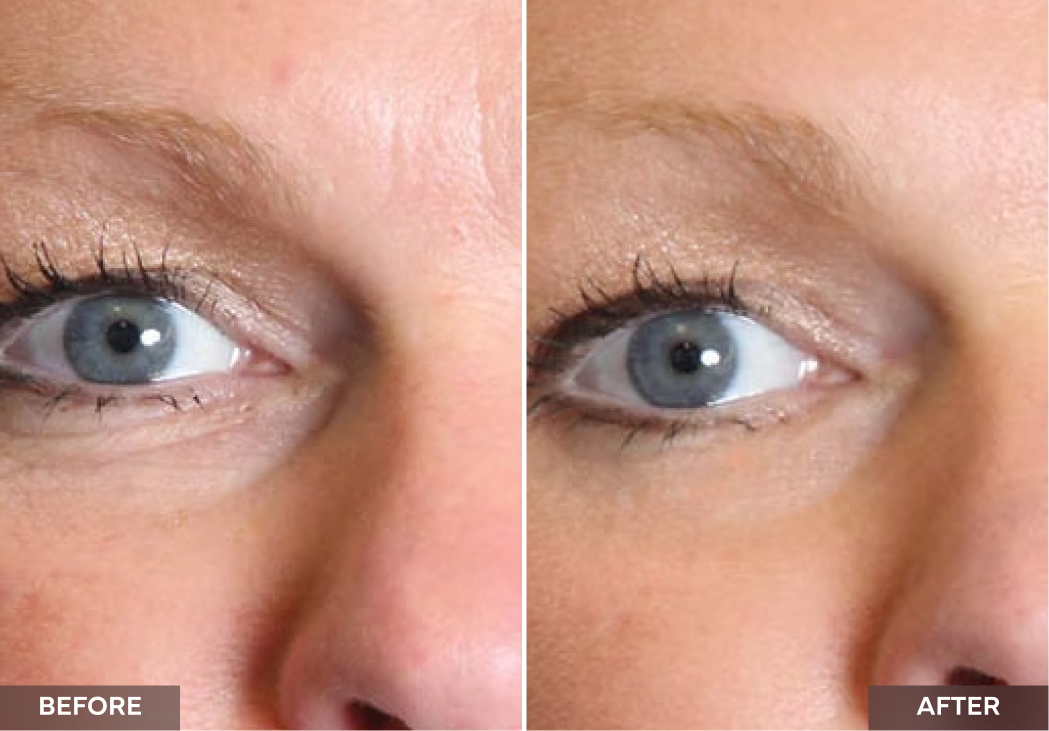 Close-up eye area before and after showing reduced wrinkles and smoother skin