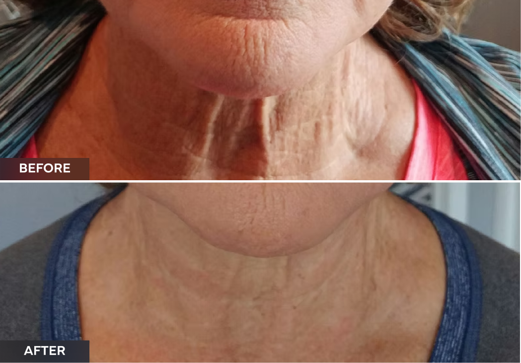 Neck and décolletage before and after showing reduced wrinkles and improved skin texture