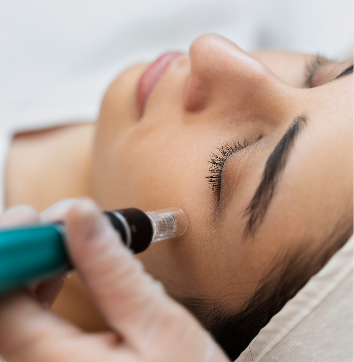 Clinician performing microneedling treatment on patient's face with handheld device