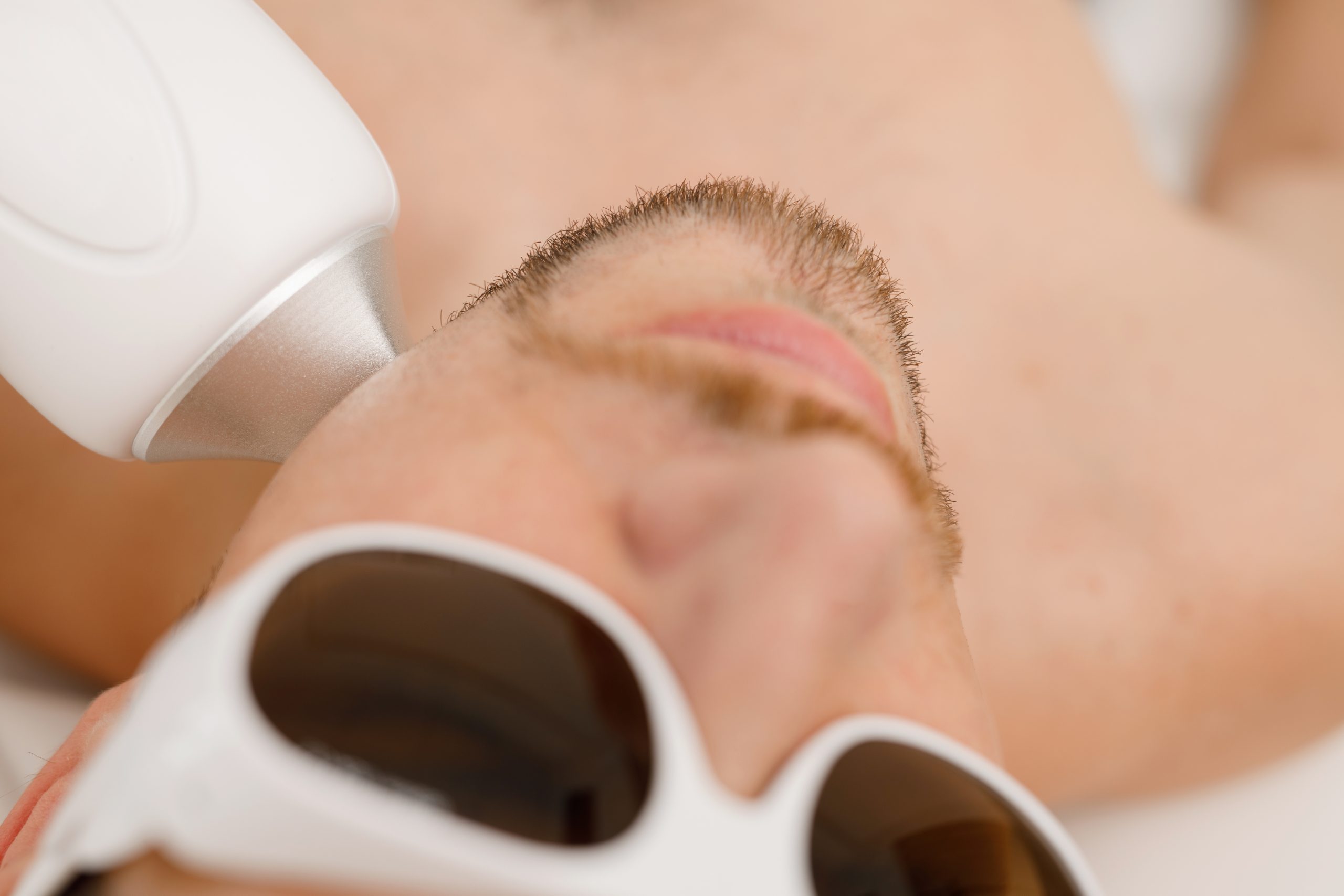 Laser hair removal device treating man's forehead and eyebrow area during facial procedure
