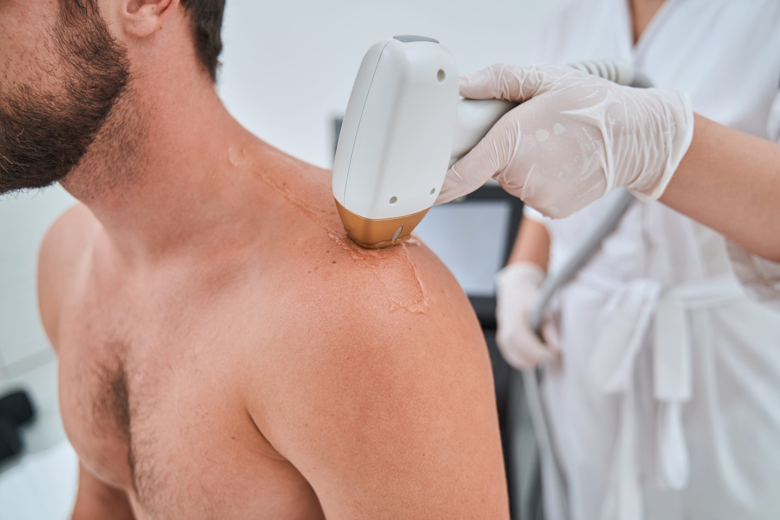 Urban Laser Denver Treatment Photo