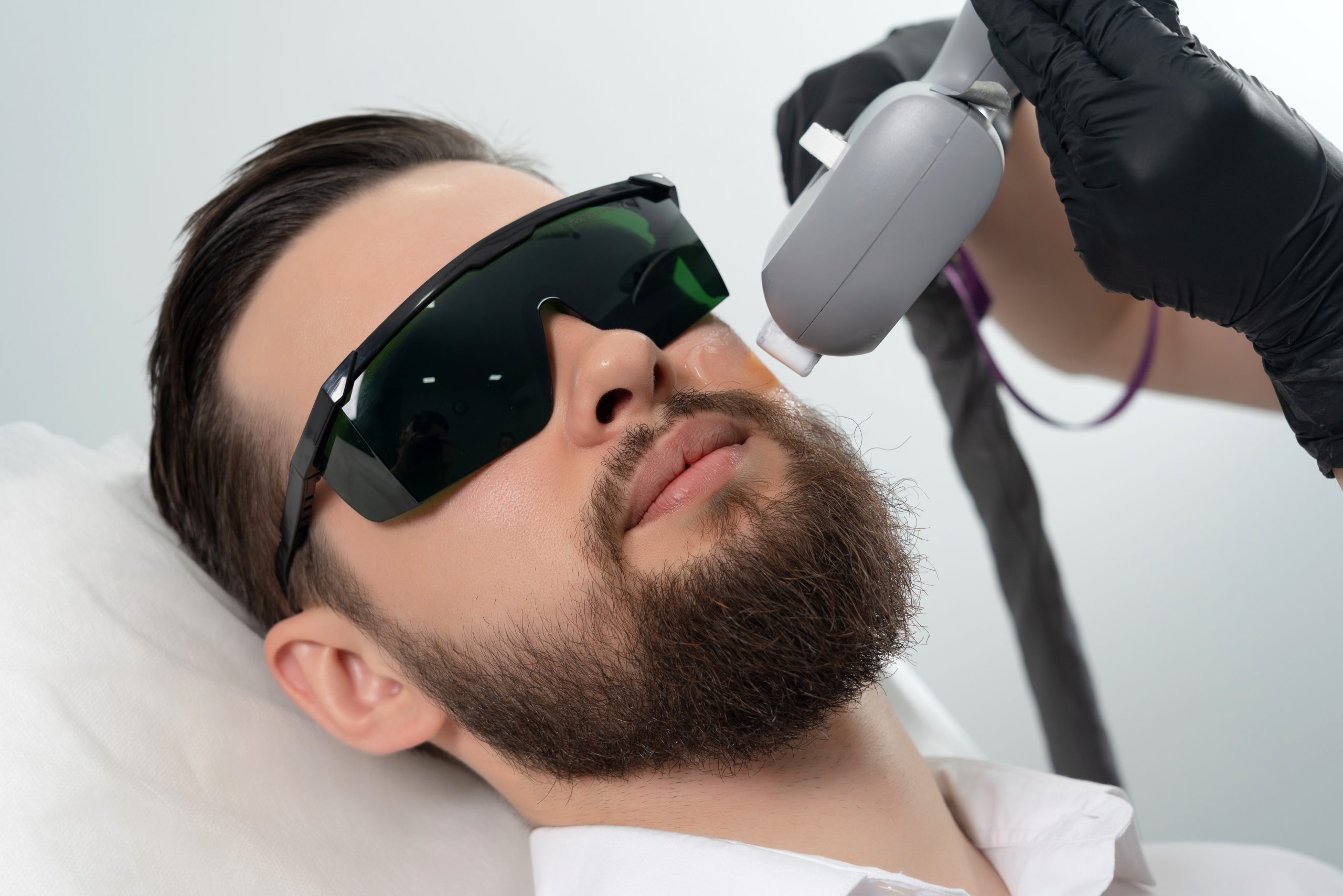 Man wearing protective eyewear receives laser hair removal treatment on his face from a technician's hand