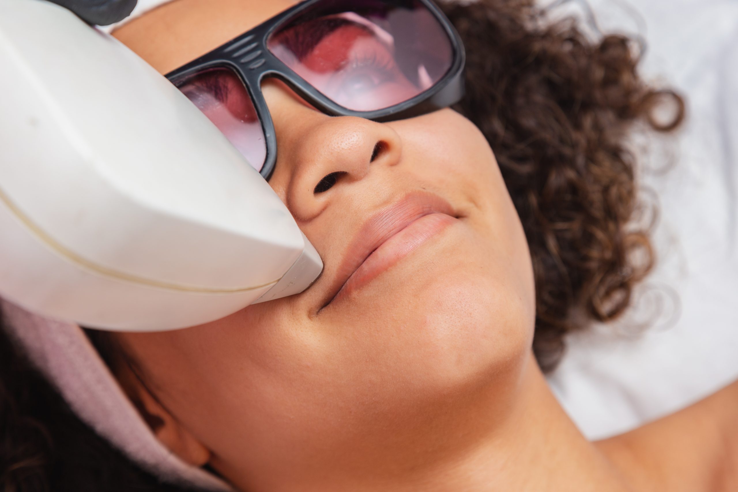 Woman wearing protective eyewear receives laser hair removal treatment on upper lip area