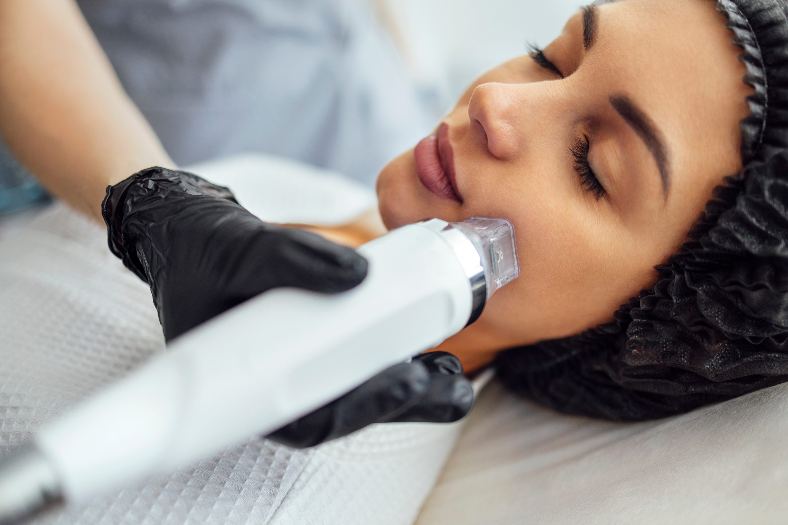 Beautician performing RF microneedling treatment on patient's cheek with handheld device