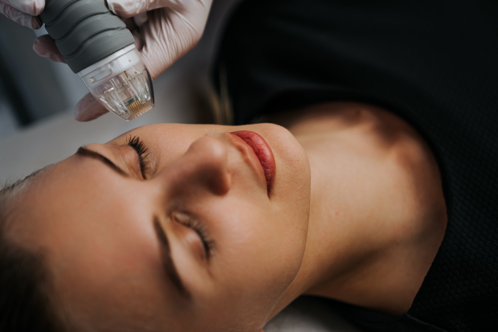 Practitioner applying RF microneedling device to patient's cheek during facial treatment