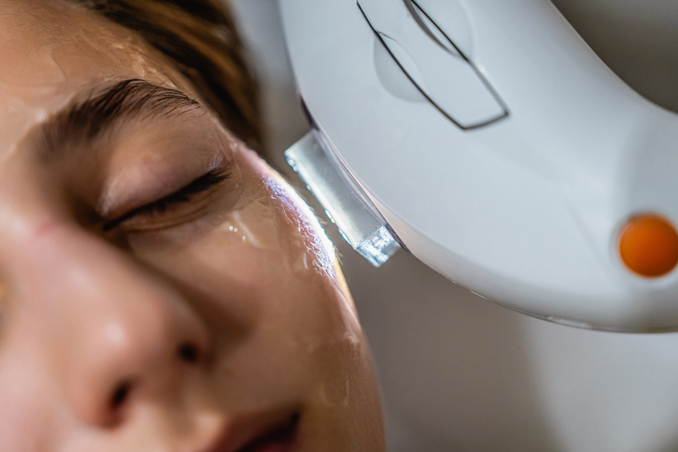 Aesthetician using IPL device on patient's face for photorejuvenation treatment