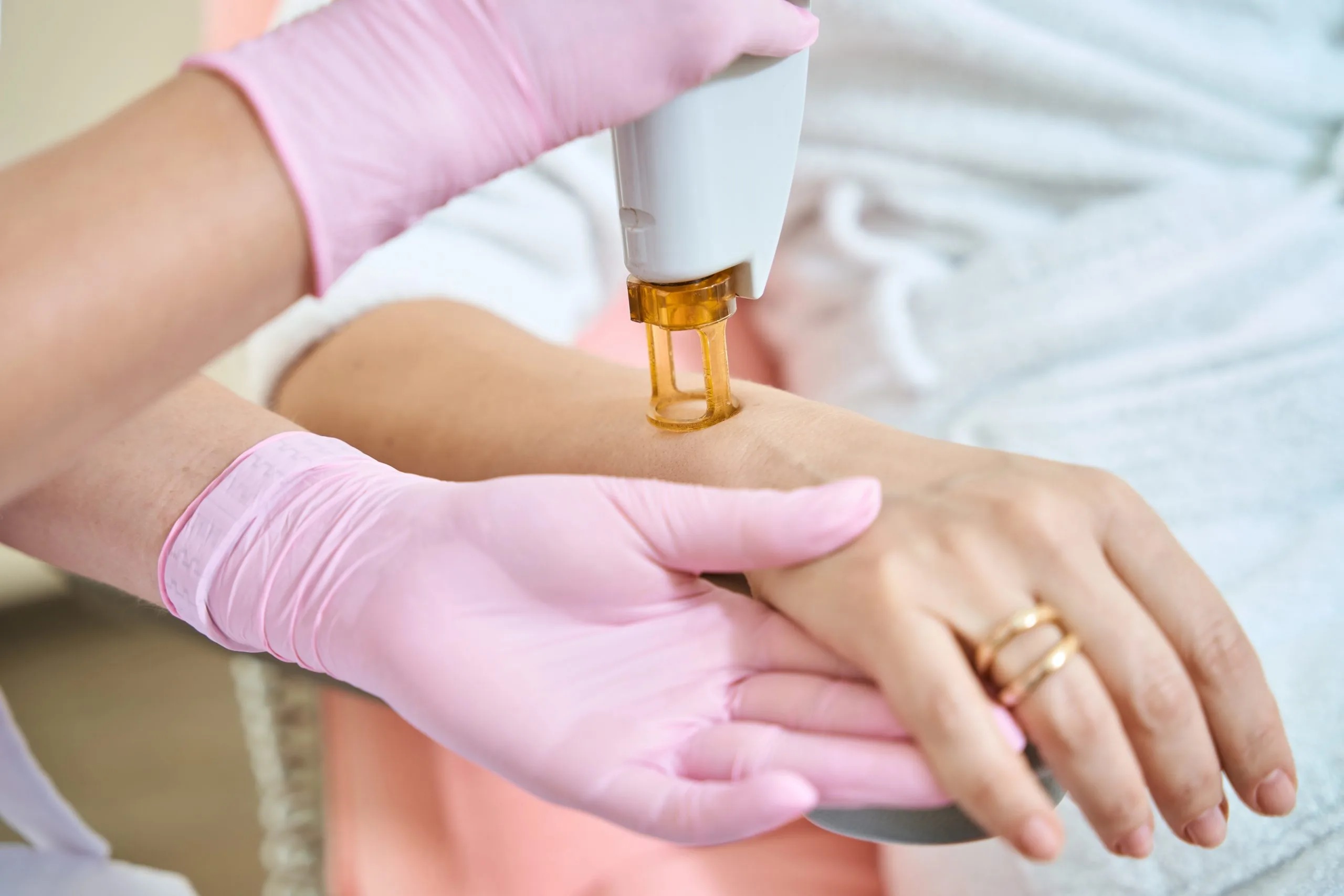 Cosmetologist performing laser hair removal treatment on a patient's hand