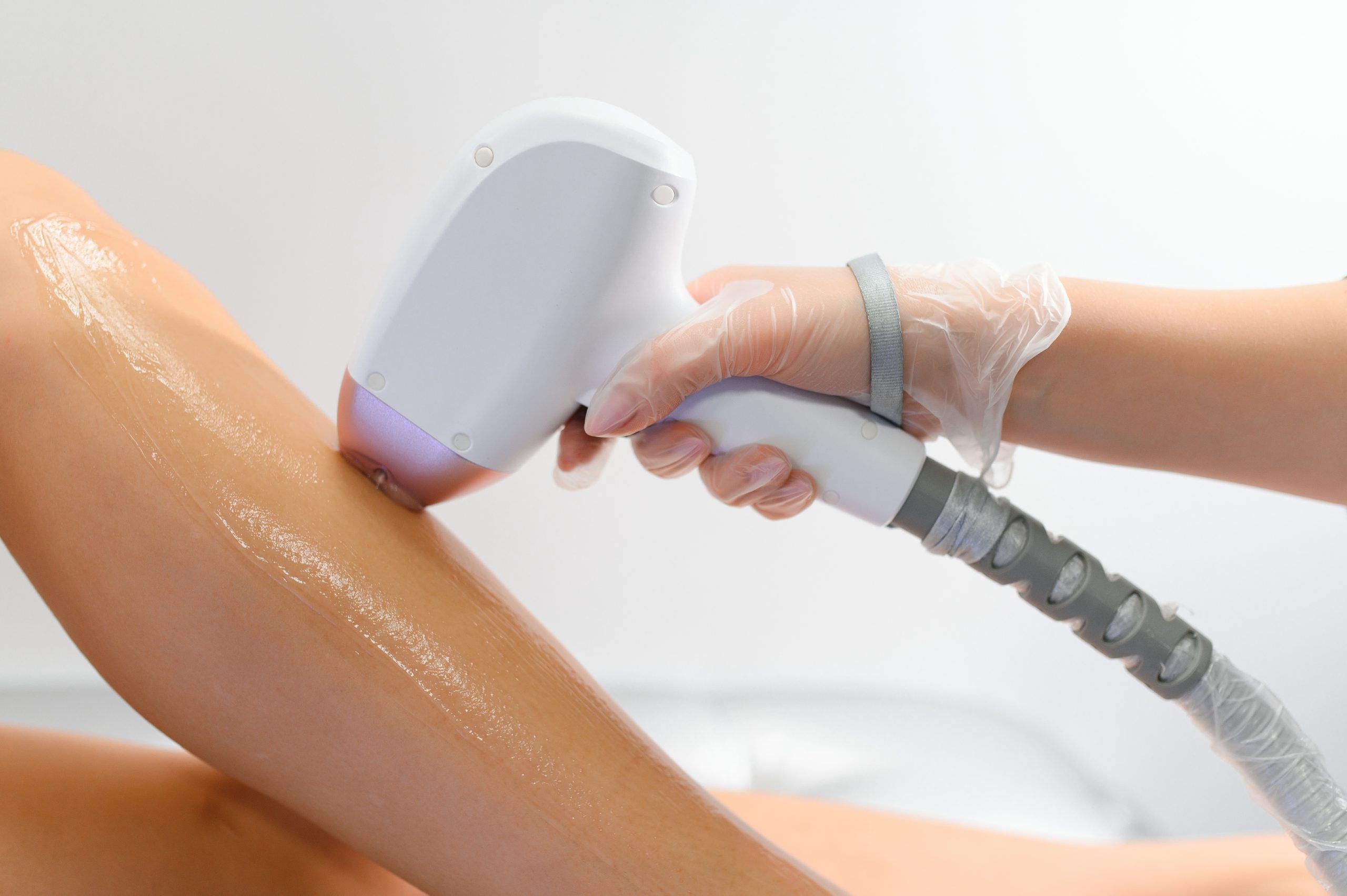 Practitioner holding a laser hair removal device against a patient's leg during treatment