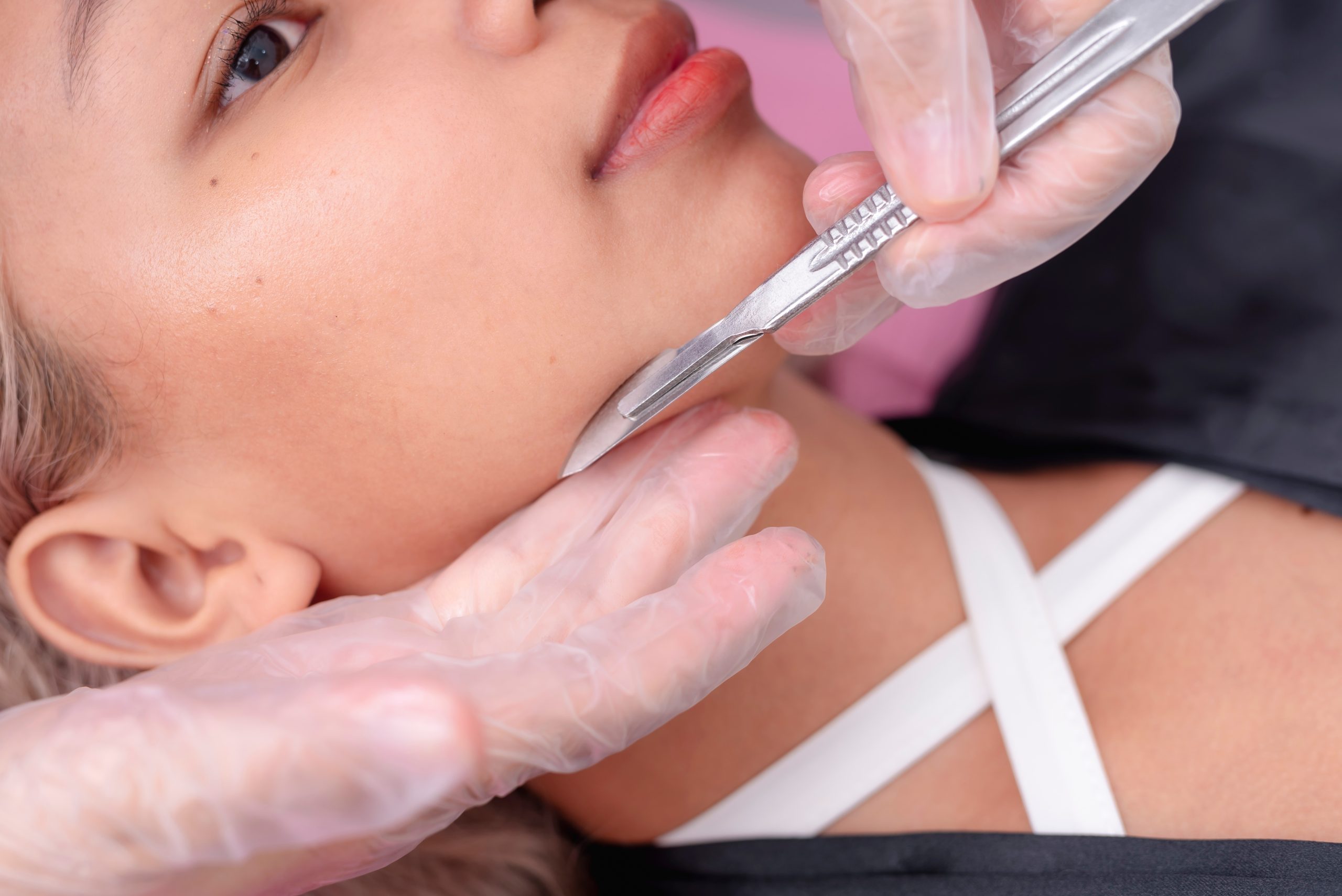 Aesthetician performing dermaplaning on a patient's cheek with a specialized blade