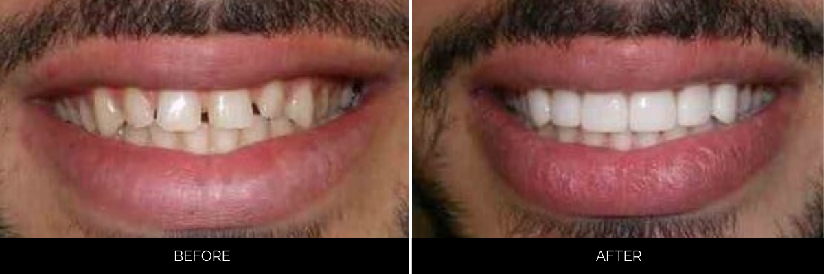 Before and after smile makeover with gapped, discolored teeth corrected to a brilliant, symmetrical smile