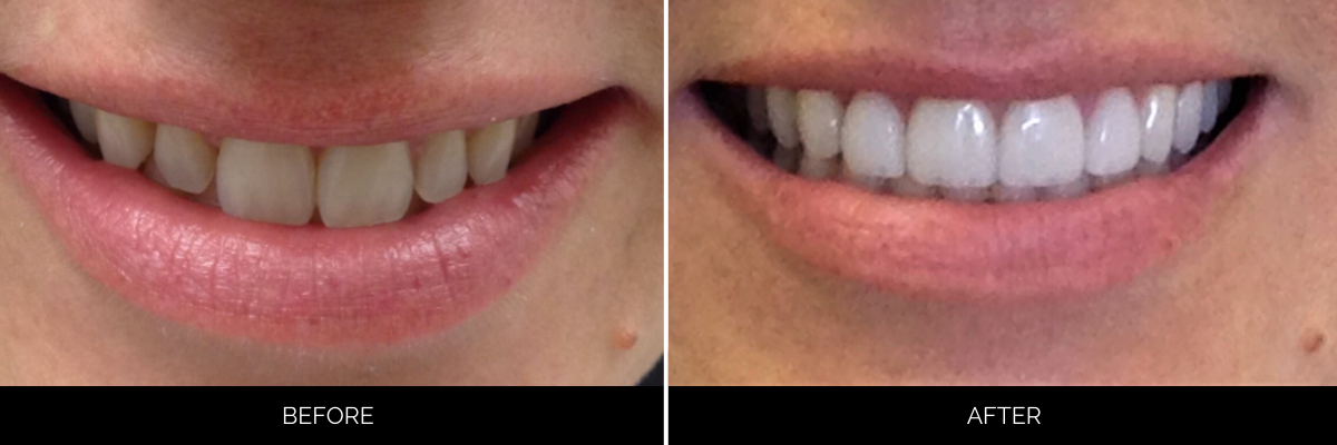 Before and after veneer treatment displaying dull, misaligned teeth transformed to a radiant, even smile