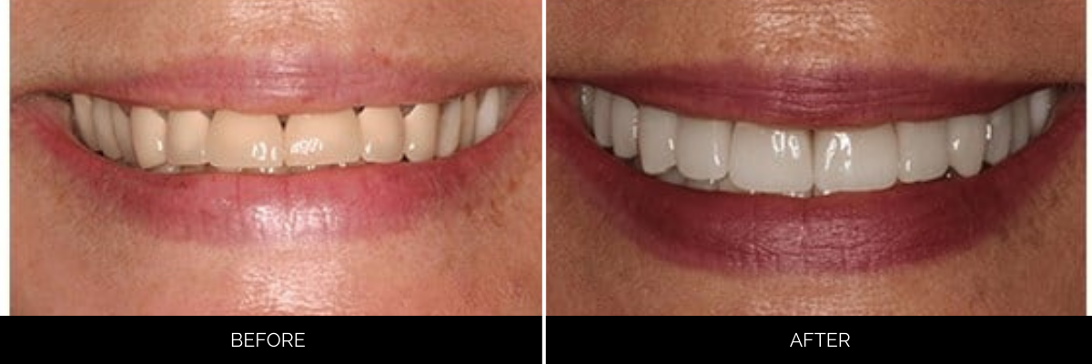 Before and after cosmetic dentistry case with yellowed, worn front teeth replaced by luminous porcelain veneers