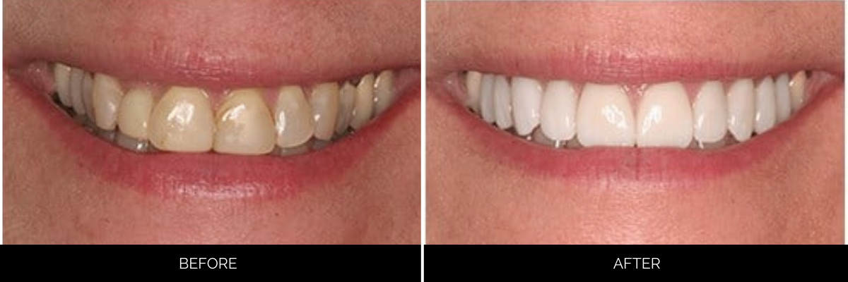 Before and after cosmetic dental treatment showing yellowed teeth brightened to a uniform white shade