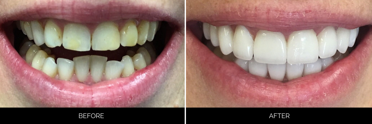 Before and after smile transformation showing discolored, uneven teeth whitened and aligned with veneers