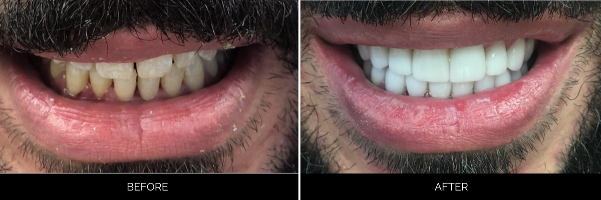 Before and after dental restoration showing whitened teeth and improved alignment