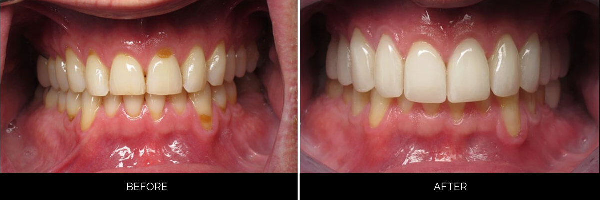 Before and after full-mouth cosmetic restoration showing yellowed upper and lower teeth whitened and restored with veneers