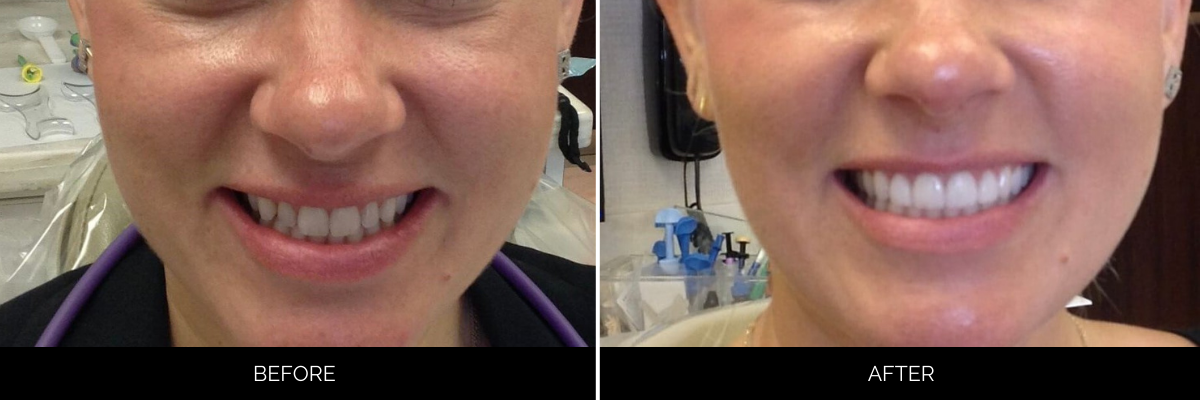 Before and after smile transformation with brighter, more uniformly shaped teeth