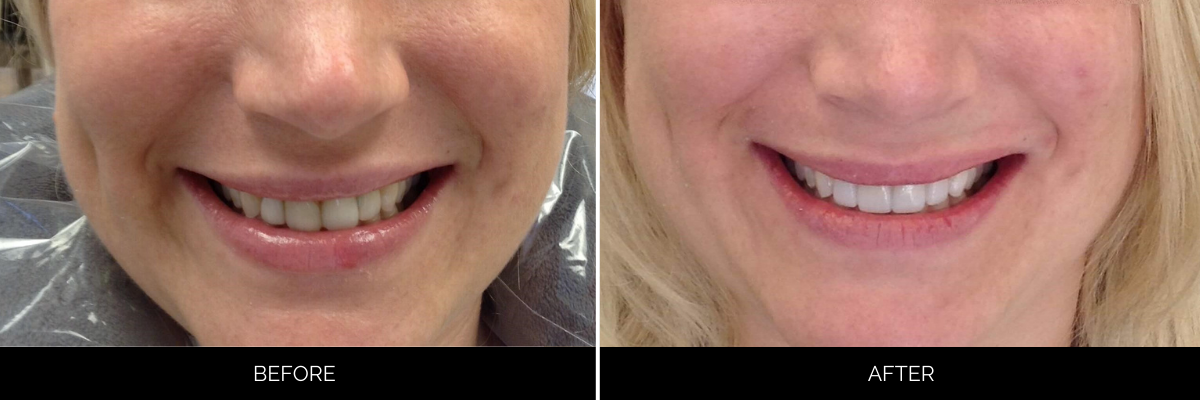 Before and after smile with whitened, evenly spaced teeth and improved gum line