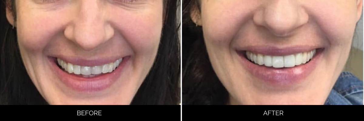 Before and after full smile transformation with improved tooth color and alignment