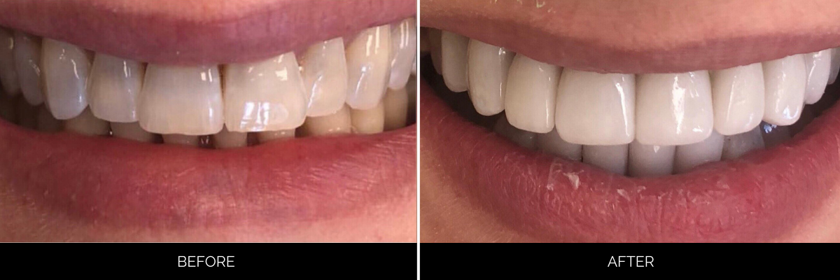 Before and after porcelain veneers showing discolored uneven teeth transformed to bright white aligned teeth