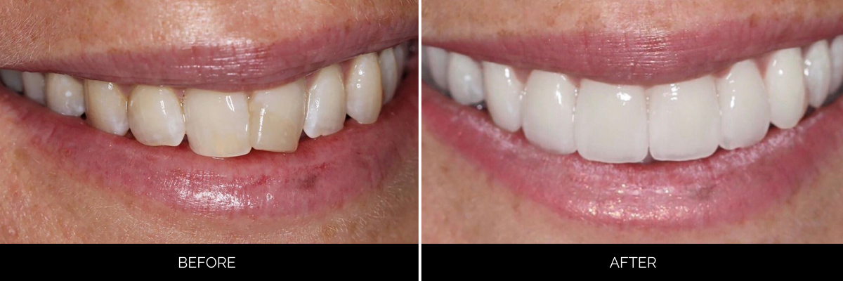Before and after veneers showing enhanced tooth color and shape from side view