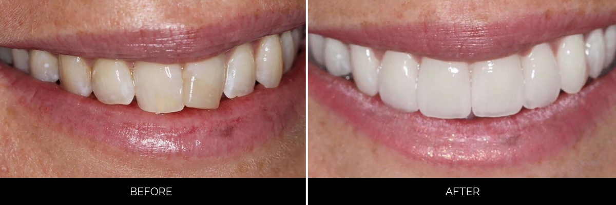 Before and after veneers showing yellowed, worn front teeth replaced with bright, even white porcelain veneers