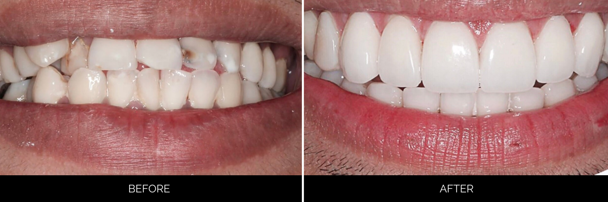 Before and after veneers treatment showing corrected alignment and whitening