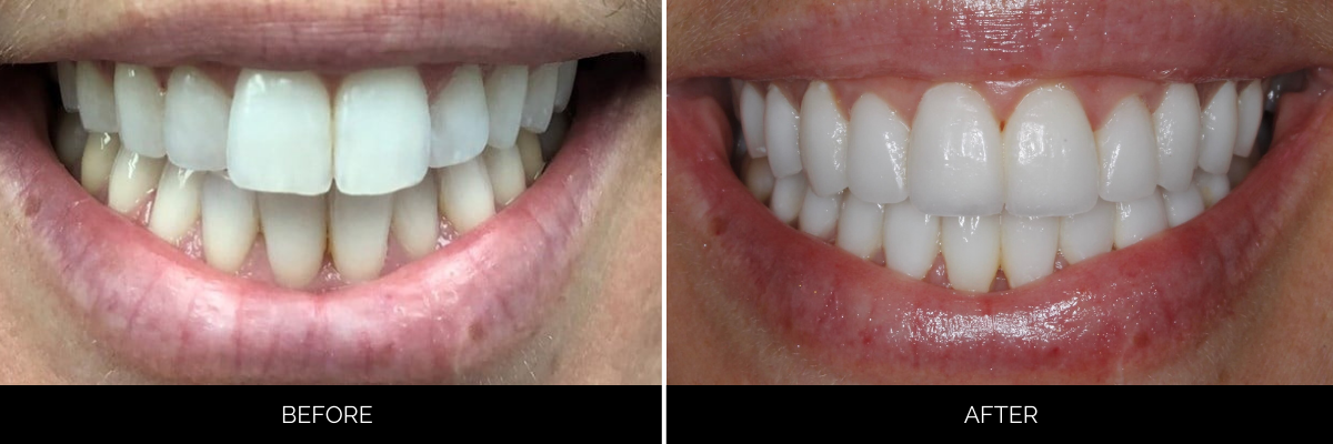 Before and after smile showing professional teeth whitening and cosmetic enhancement results