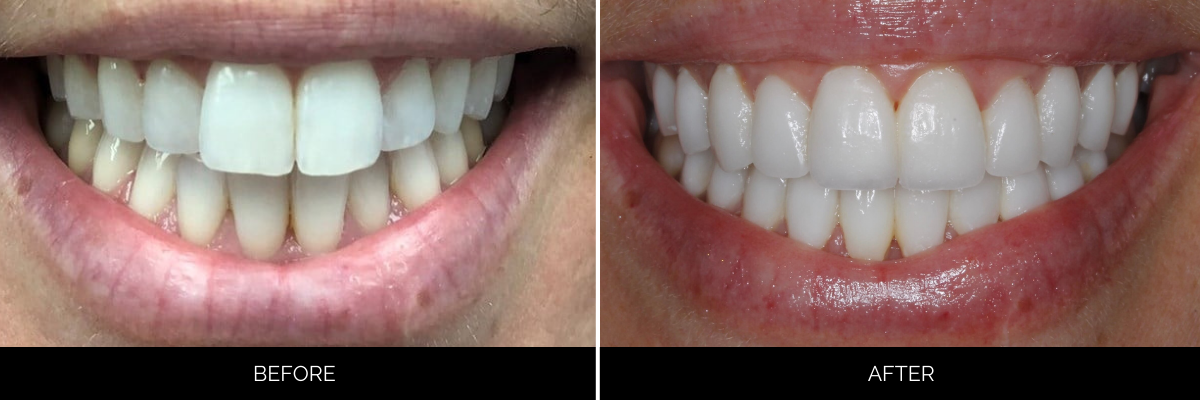 Before and after smile makeover showing discolored, uneven teeth transformed to bright, uniform white veneers