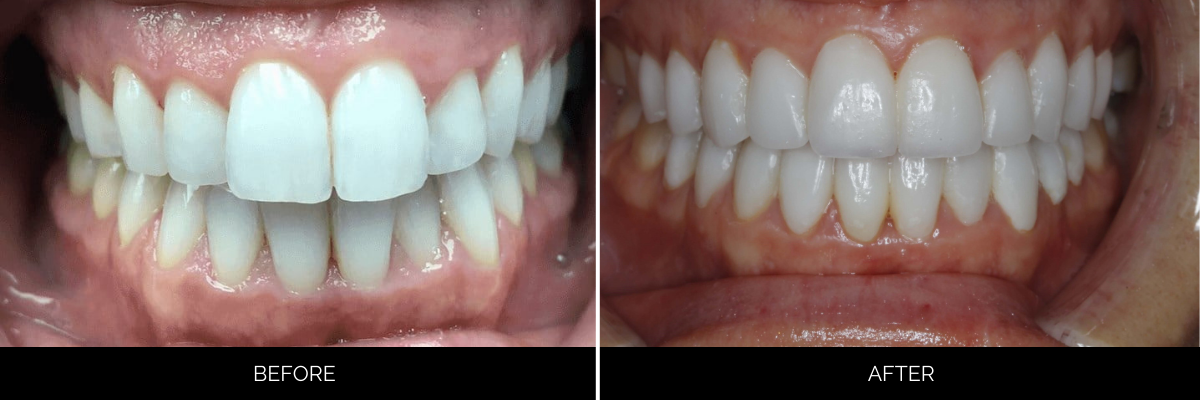 Before and after cosmetic dental treatment showing improved tooth alignment and whiteness