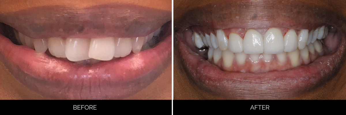 Before and after cosmetic dentistry showing aligned and brightened smile
