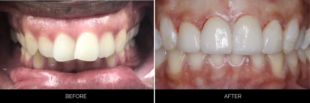 Before and after frontal view of smile enhancement with professional whitening and veneers